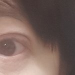 저 재수술 잘 됐는지 봐 주세요 ㅠ