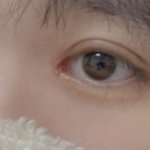 <b>실밥</b> 빼고 붓기 빨리 빠져야되는데