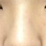 코 평가 +<b>시술</b>이나수술추첝ㅎㅁ