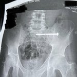 [드루와] 스키타다 나무에 부딪혀서 뒤질뻔 ^^