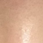 [댓글부탁해] 쌍수 1주일차 붓기 어떰??