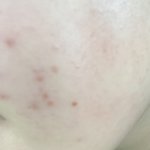 [댓글부탁해] <b>좁쌀</b> 여드름 ? 이런 거 흉터 어떻게 없애 ㅜ?