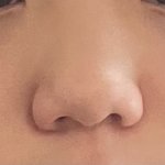 고1 코수술