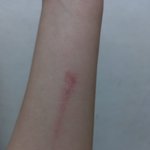 [댓글부탁해] 너무 힘들어 (상처 사진)