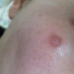 피부토<b>닝</b>하고 2도화상입었어요ㅠㅠ조심하세요...