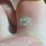 [혐주의] 얘들아 <b>발사</b>마귀 이거 나아지는거같음??