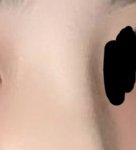 [댓글부탁해] 코수술 <b>티남</b>?