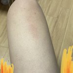 더러움/혐) 얘들아 이거 피부병이야?