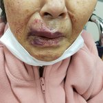 [이것좀봐줘] 폭행으로 양쪽 쇄골과 갈비뼈 8개가 부러졌습니다....