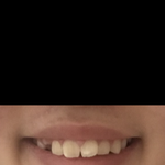 [조언부탁해] 나 <b>덧니</b> 어때?