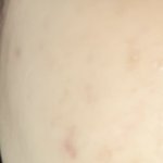 [ㅈㄱㄴ] 여드름 <b>흉터</b> 없애본사람.. 조언좀 ㅜㅜ(약혐)