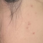 진심 이런 여드름 <b>흉터</b> 어케 없야야됨 ㅠㅠㅠ
