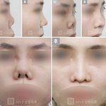판에 코<b>수술</b>할까 하는애들중에 못생긴코 열명중 한두명임
