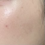 [댓글부탁해] 이거 <b>편평</b>사마귀야?
