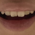 [드루와] 나 치아 왜 <b>이질</b><b>알</b>임..??