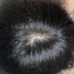 20대 여자 <b>탈모</b>
