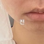 입꼬리 성형수술 후기
