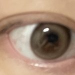 [댓글부탁해] <b>쌍수</b> 자연으로 푸는법 없나 ㅠ