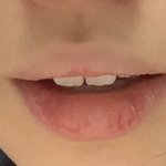 나 앞니 교정아니면 <b>레진</b>할까 알려줘