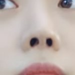 이거 빼<b>박</b> 코수술임?