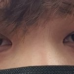 24살 눈주름 올렸던 사람인데