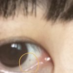 [드루와] <b>흰자</b>에 빨간점 생겼는데 뭐냐 이거