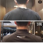 아진짜걍 승모근 <b>필러</b> 맞아야하나