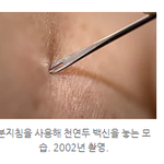 원숭이두창 - 분지침