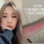 간미연 <b>화상</b>입은거보소ㄷㄷㄷㄷ