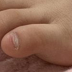 나 새끼발가락<b>발톱</b>이 없는데 어카냐ㅠㅠ