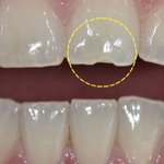 남친 때문에 <b>앞니</b>가 깨졌는데