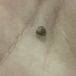 (약혐) 얘들아 나 피부에서 돌 나옴;