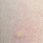 [ㅈㄱㄴ] 얘들아 ㅅㅂ 모기 물린 데 엄청 부음