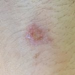 [댓글부탁해] 목 뒤 모기에 물렸는데 <b>진물</b>이 나요(혐주의)