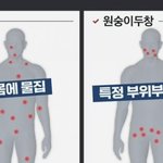 <b>원두</b>창 증상 부위
