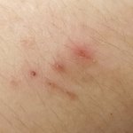 [드루와] 나 원숭이 두창 의심 개많이 받을듯