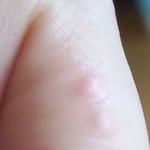 나도 <b>습진</b> 조카 잘남1