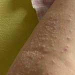 아토피 너무 심해짐 어<b>카지</b>