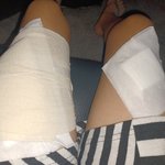 편의점에서 11세아이가 화상을 입었습니다