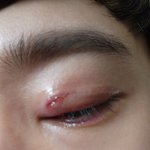 판은 처음 써보네요ㅠ <b>다래끼</b>....