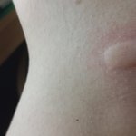 [19] 모기 물린 <b>자국</b>  미친듯
