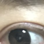 쌍수 개망함 붓기 안빠져 3년<b>지남</b>ㅋㅋ