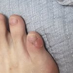 이거<b>물집</b>임?