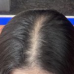 야 나 <b>탈모</b>같음?