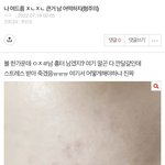 [댓글부탁해] 여드름 잘 아는 사람?? 도와줘ㅠㅠ(혐주의)
