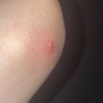 나 이거 걍 <b>벌레</b>물린거지?