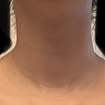 [댓글부탁해] 승모근 없애면 목이 너무 길어 보일까? (<b>사진</b> <b>O</b>)