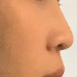 [댓글부탁해] 너네라면 코 할거야 교정 할거야 (사진있음)
