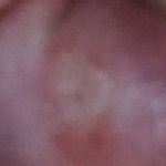 입 안에 <b>고름</b> 차본 사람 잇냐(혐주의)