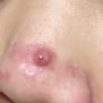 [조언부탁해] 이런 여드름? <b>염증</b>?은 어떻게 해야하는거야??